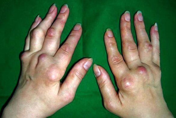Hands affected by deformity of polyosteoarthritis