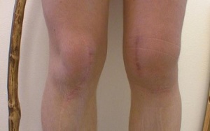 Stages of development of knee arthrosis